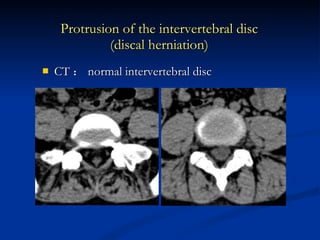 CT ： normal intervertebral disc Protrusion of the intervertebral disc (discal herniation) 