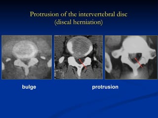 Protrusion of the intervertebral disc (discal herniation) bulge  protrusion 