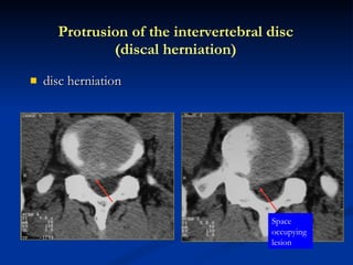 disc herniation Protrusion of the intervertebral disc (discal herniation) Space occupying lesion 