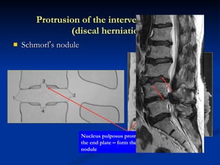 Schmorl ’ s nodule Protrusion of the intervertebral disc (discal herniation) Annulus fibrosis Nucleus pulposus protruded into the end plate  –  form the Schmorl ’ s nodule 