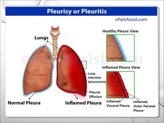 pneumonia