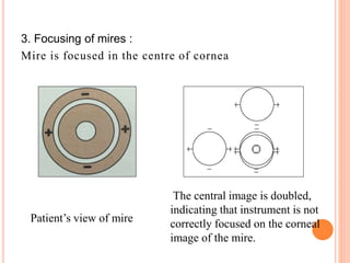 3. Focusing of mires :
Mire is focused in the centre of cornea
Patient’s view of mire
The central image is doubled,
indicating that instrument is not
correctly focused on the corneal
image of the mire.
 