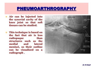 PNEUMOARTHROGRAPHY
 Air can be injected into
the synovial cavity of the
knee joint so that soft
tissues can be studied.
 This technique is based on
the fact that air is less
radiopaque than
structures such as the
medial and lateral
menisci, so their outline
can be visualized on a
radiograph .
Dr M Eladl
 