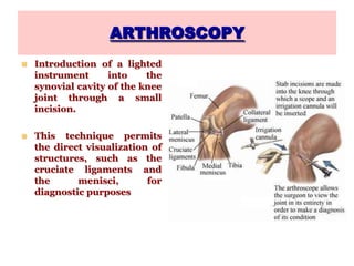 ARTHROSCOPY
 Introduction of a lighted
instrument into the
synovial cavity of the knee
joint through a small
incision.
 This technique permits
the direct visualization of
structures, such as the
cruciate ligaments and
the menisci, for
diagnostic purposes
 