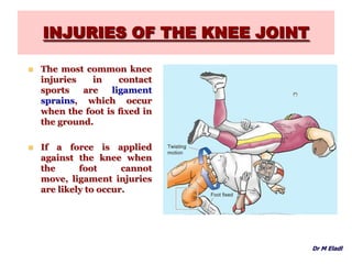 INJURIES OF THE KNEE JOINT
 The most common knee
injuries in contact
sports are ligament
sprains, which occur
when the foot is ﬁxed in
the ground.
 If a force is applied
against the knee when
the foot cannot
move, ligament injuries
are likely to occur.
Dr M Eladl
 