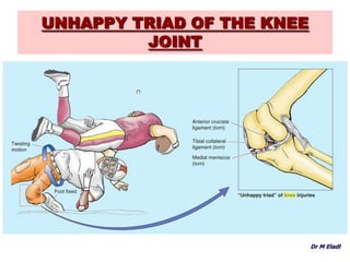 UNHAPPY TRIAD OF THE KNEE
JOINT
Dr M Eladl
 