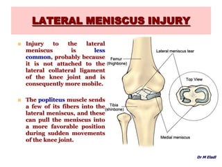 LATERAL MENISCUS INJURY
 Injury to the lateral
meniscus is less
common, probably because
it is not attached to the
lateral collateral ligament
of the knee joint and is
consequently more mobile.
 The popliteus muscle sends
a few of its fibers into the
lateral meniscus, and these
can pull the meniscus into
a more favorable position
during sudden movements
of the knee joint.
Dr M Eladl
 