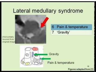 Lateral medullary syndrome {Wallenberg Syndrome}