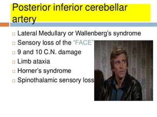 Lateral medullary syndrome {Wallenberg Syndrome}