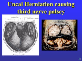 Uncal Herniation causing
third nerve palsey
 