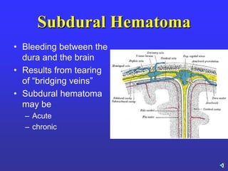 Subdural Hematoma
• Bleeding between the
dura and the brain
• Results from tearing
of ―bridging veins‖
• Subdural hematoma
may be
– Acute
– chronic
 