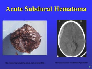 Acute Subdural Hematoma
http://www.emedicine.com/EMERG/topic560.htmhttp://www.neuroanatomy.hpg.ig.com.br/brain.htm
 