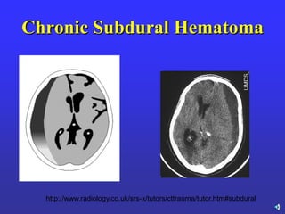 Chronic Subdural Hematoma
http://www.radiology.co.uk/srs-x/tutors/cttrauma/tutor.htm#subdural
 