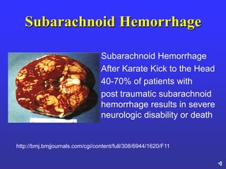 Subarachnoid Hemorrhage
Subarachnoid Hemorrhage
After Karate Kick to the Head
40-70% of patients with
post traumatic subarachnoid
hemorrhage results in severe
neurologic disability or death
http://bmj.bmjjournals.com/cgi/content/full/308/6944/1620/F11
 