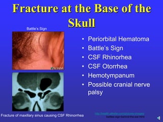 Fracture at the Base of the
Skull
• Periorbital Hematoma
• Battle’s Sign
• CSF Rhinorhea
• CSF Otorrhea
• Hemotympanum
• Possible cranial nerve
palsy
Fracture of maxillary sinus causing CSF Rhinorrhea
Battle’s Sign
images/-http://health.allrefer.com/pictures
battles-sign-behind-the-ear.html
 