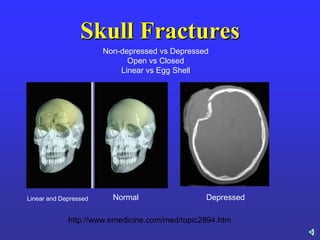 Skull Fractures
Linear and Depressed Normal Depressed
Non-depressed vs Depressed
Open vs Closed
Linear vs Egg Shell
http://www.emedicine.com/med/topic2894.htm
 