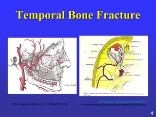 Temporal Bone Fracture
http://www.vh.org/adult/provider/anatomy/
AnatomicVariants/Cardiovascular/Images0300/0386.htmlhttp://www.bartleby.com/107/illus510.html
 