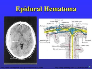 Epidural Hematoma
http://www.bartleby.com/107/illus769.htmlhttp://www.chestjournal.org/cgi/content/full/122/2/699
 