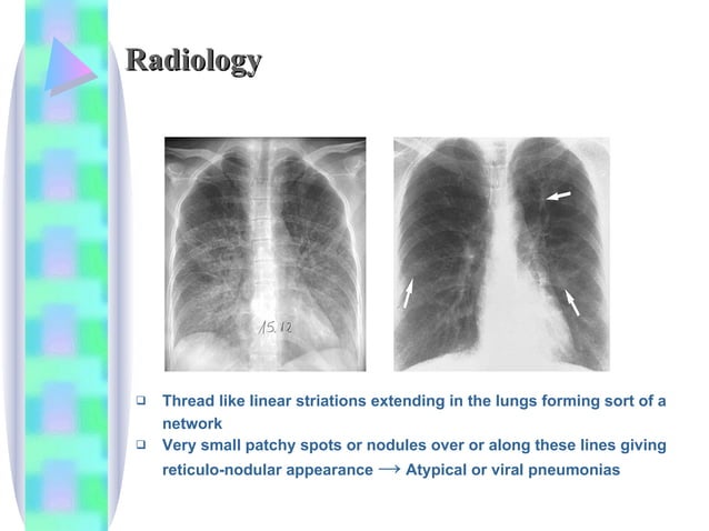 Legionella+Mycoplasma+Atypical Pneumonia