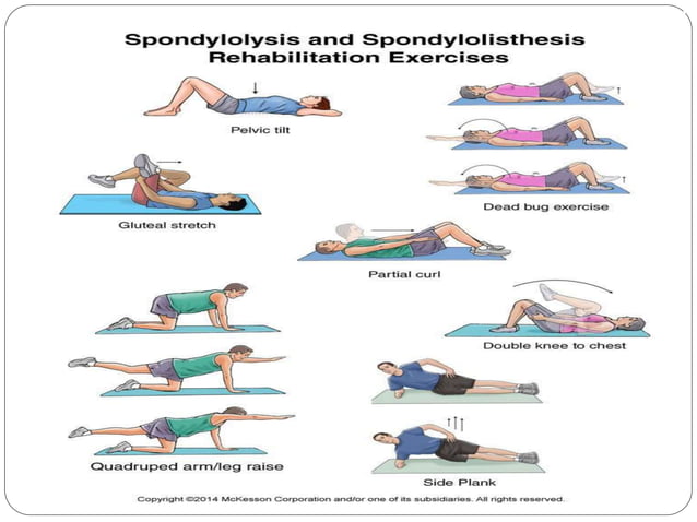 Lumbar Spondylosis, Spondylolisthesis and Radiculopathy | PPT