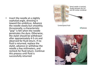 • Insert the needle at a slightly
cephalad angle, directing it
toward the umbilicus. Advance
the needle slowly but smoothly.
Occasionally, a characteristic
“pop” is felt when the needle
penetrates the dura. Otherwise,
the stylet should be withdrawn
after approximately 4-5 cm and
observed for fluid return. If no
fluid is returned, replace the
stylet, advance or withdraw the
needle a few millimeters, and
recheck for fluid return. Continue
this process until fluid is
successfully returned
 