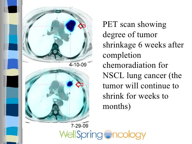 Cancer On Pet Scan Tomotherapy Tumor Shrinkage Nscl - lahzehphotography