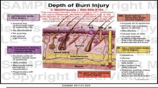 Management of burns   