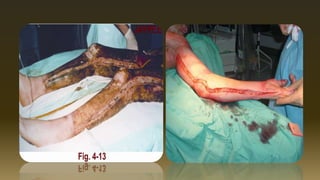 Management of burns   