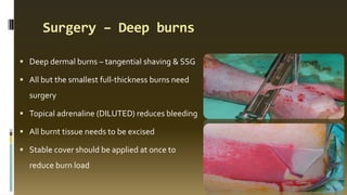 Surgery – Deep burns
 Deep dermal burns – tangential shaving & SSG
 All but the smallest full-thickness burns need
surgery
 Topical adrenaline (DILUTED) reduces bleeding
 All burnt tissue needs to be excised
 Stable cover should be applied at once to
reduce burn load
 