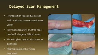 Delayed Scar Management
 Transposition flaps and Z-plasties
with or without tissue expansion are
useful
 Full-thickness grafts and free flaps –
needed for large or difficult areas
 Hypertrophy - treated with pressure
garments
 Pharma.treatment of itch is
important
 