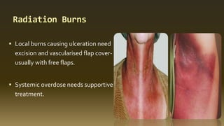 Radiation Burns
 Local burns causing ulceration need
excision and vascularised flap cover-
usually with free flaps.
 Systemic overdose needs supportive
treatment.
 