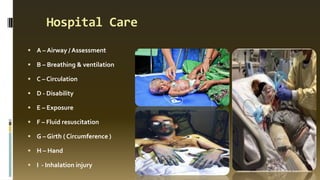 Hospital Care
 A – Airway / Assessment
 B – Breathing & ventilation
 C – Circulation
 D - Disability
 E – Exposure
 F – Fluid resuscitation
 G – Girth ( Circumference )
 H – Hand
 I - Inhalation injury
 