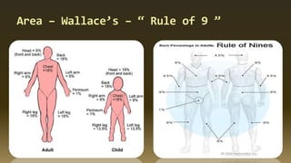 Area – Wallace’s – “ Rule of 9 ”
 