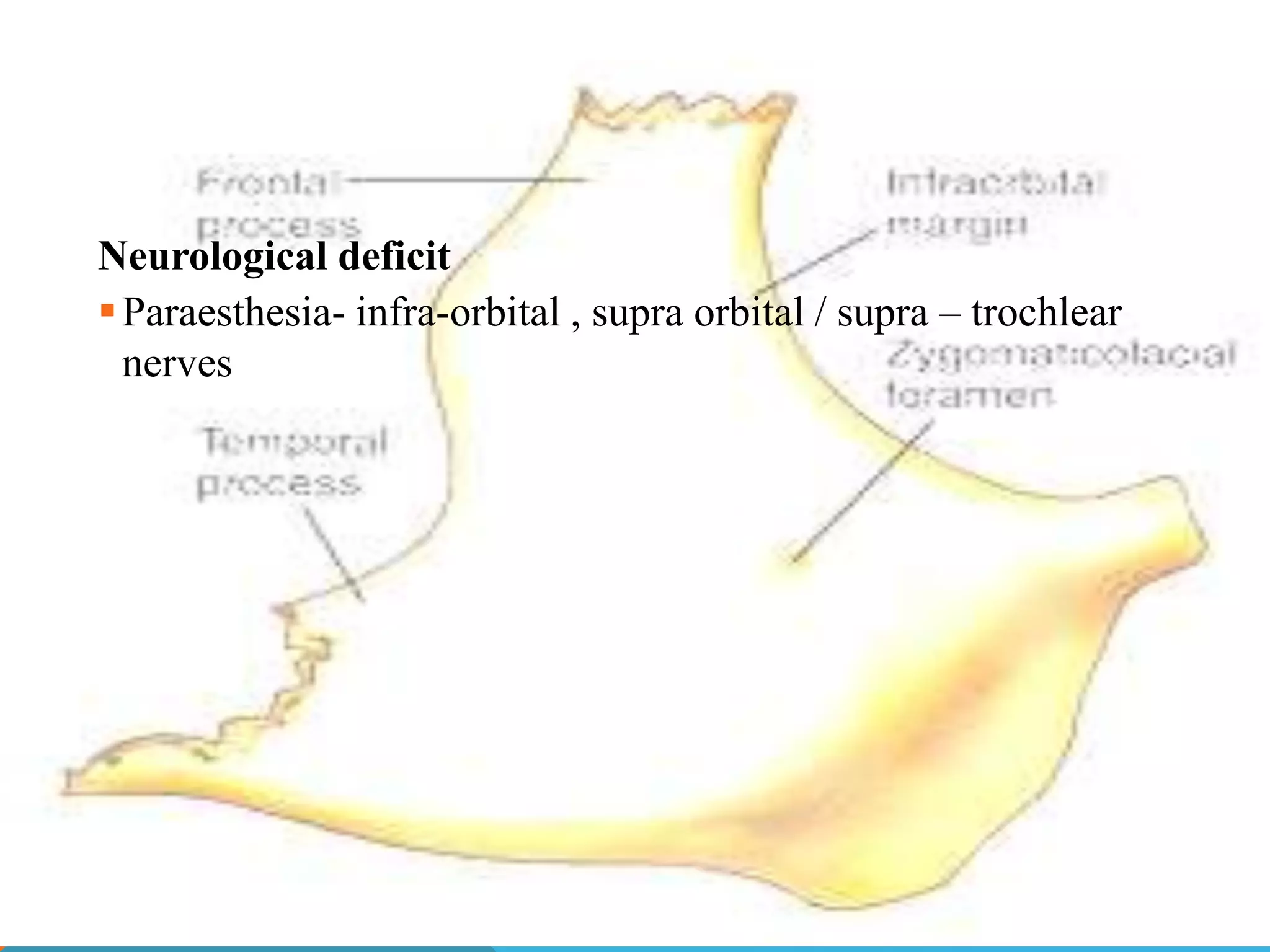 Management of zygomaticomaxillary complex fractures ih | PPT