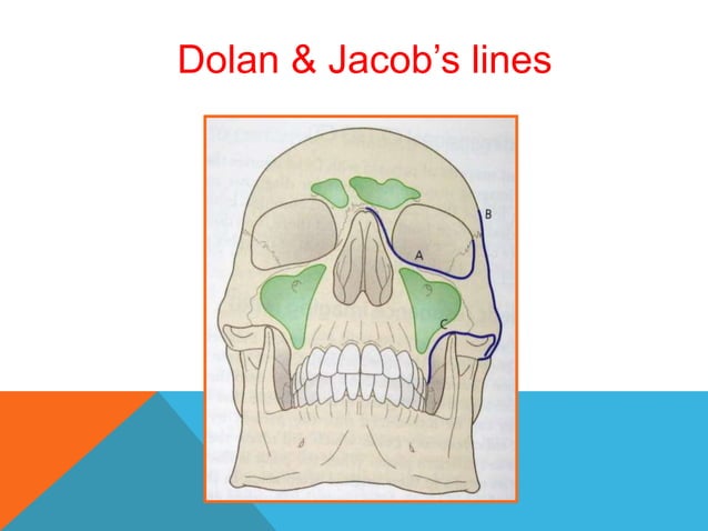 Management of zygomaticomaxillary complex fractures ih | PPT