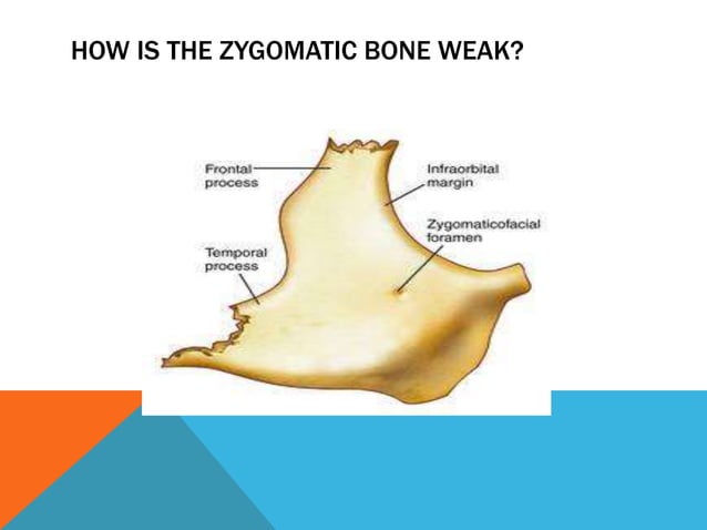 Management of zygomaticomaxillary complex fractures ih | PPT