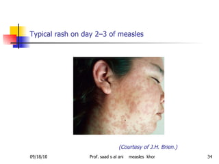 Typical rash on day 2–3 of measles    (Courtesy of J.H. Brien.) 