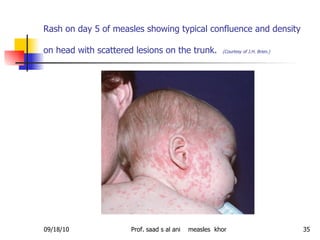 Rash on day 5 of measles showing typical confluence and density on head with scattered lesions on the trunk.   (Courtesy of J.H. Brien.)   