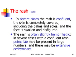 The rash  (cont.) In  severe cases  the rash is  confluent , the skin is completely covered, including the palms and soles, and the face is swollen and disfigured.  The rash is  often slightly hemorrhagic ; in severe cases with a confluent rash,  petechiae  may be present in large numbers, and there may be  extensive ecchymoses  