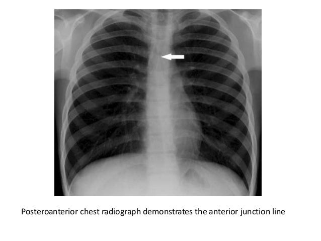 Mediastinum-RADIOLOGY