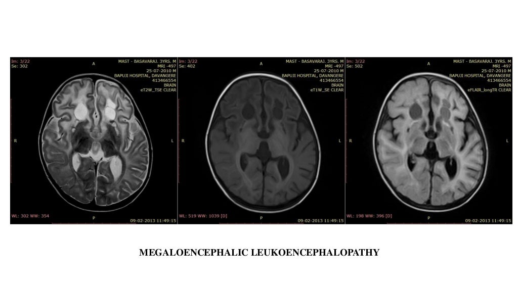 Mri in white matter diseases