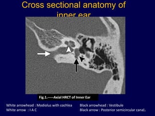 Cross sectional anatomy of
                 inner ear




                   Fig.1.-----Axial HRCT of Inner Ear

White arrowhead : Modiolus with cochlea       Black arrowhead : Vestibule
White arrow : I A C                           Black arrow : Posterior semicircular canal
                                                                                       18
 