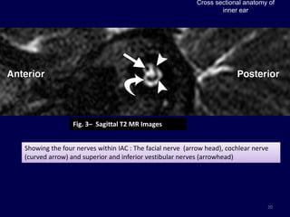 Cross sectional anatomy of
                                                                 inner ear




                Fig. 3– Sagittal T2 MR Images


Showing the four nerves within IAC : The facial nerve (arrow head), cochlear nerve
(curved arrow) and superior and inferior vestibular nerves (arrowhead)




                                                                                 20
 