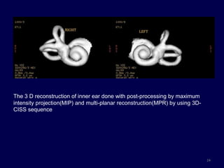 The 3 D reconstruction of inner ear done with post-processing by maximum
intensity projection(MIP) and multi-planar reconstruction(MPR) by using 3D-
CISS sequence




                                                                              24
 