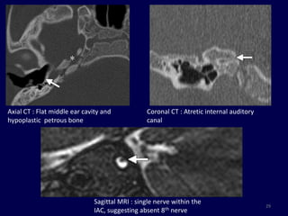 Axial CT : Flat middle ear cavity and           Coronal CT : Atretic internal auditory
hypoplastic petrous bone                        canal




                              Sagittal MRI : single nerve within the
                                                                                         29
                              IAC, suggesting absent 8th nerve
 