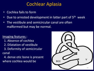 Cochlear Aplasia
• Cochlea fails to form
• Due to arrested development in latter part of 5th week
• The vestibule and semicircular canal are often
  malformed but may be normal.

Imaging features :
 1. Absence of cochlea
 2. Dilatation of vestibule
 3. Deformity of semicircular
canal
 4. dense otic bone is present
where cochlea would be
                                                           32
 