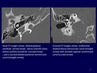 Axial CT images shows dilated globose            Coronal CT images shows malformed
vestibule (arrow head) , dense sclerotic bone    dilated lateral semicircular canal (straight
where cochlea should be (curved arrow)           arrow) with stunted superior semicircular
, and a stunted dilated posterior semicircular   canal (curved arrow)
canal (straight arrow).



                                                                                        33
 