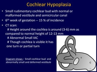 Cochlear Hypoplasia
• Small rudimentary cochlear bud with normal or
  malformed vestibule and semicircular canal
• 6th week of gestation -- 15 % of incidence
• CT scan:
   # Height around the cochlea is around (3-6) mm as
  compared to normal height of 12-13 mm
   # Abnormal Small IAC
   # Though cochlea is visible it has
   one turn or partial turn


  Diagram shows : Small cochlear bud and
  abnormally small and deformed vestibule

                                                       34
 