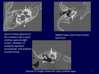 Axial CT shows absence of                       Slightly lower level shows normal
the modiolus with a cystic                      basal turn
cochlear apex (straight
arrow) , dilatation of
vestibular aqueduct
(arrowhead) and vestibule
(curved arrow)




                                                                                    37
                    Coronal CT images shows the cystic cochlear apex
 