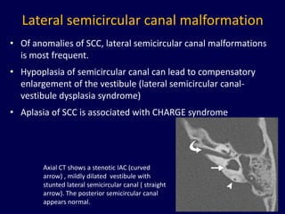 Lateral semicircular canal malformation
• Of anomalies of SCC, lateral semicircular canal malformations
  is most frequent.
• Hypoplasia of semicircular canal can lead to compensatory
  enlargement of the vestibule (lateral semicircular canal-
  vestibule dysplasia syndrome)
• Aplasia of SCC is associated with CHARGE syndrome




        Axial CT shows a stenotic IAC (curved
        arrow) , mildly dilated vestibule with
        stunted lateral semicircular canal ( straight
        arrow). The posterior semicircular canal
        appears normal.                                       38
 